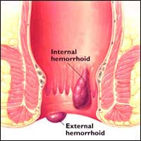 hemorrhoid